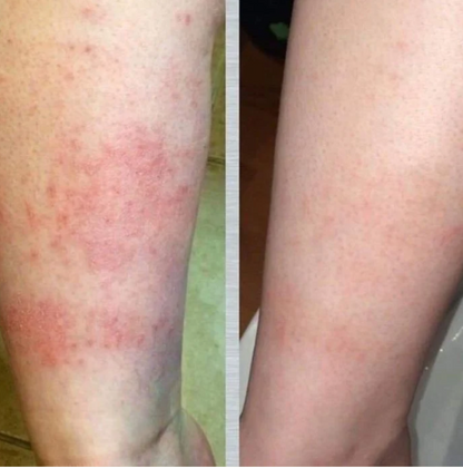 Whipped tallow face cream and balm showing smoother, more even arm skin tone